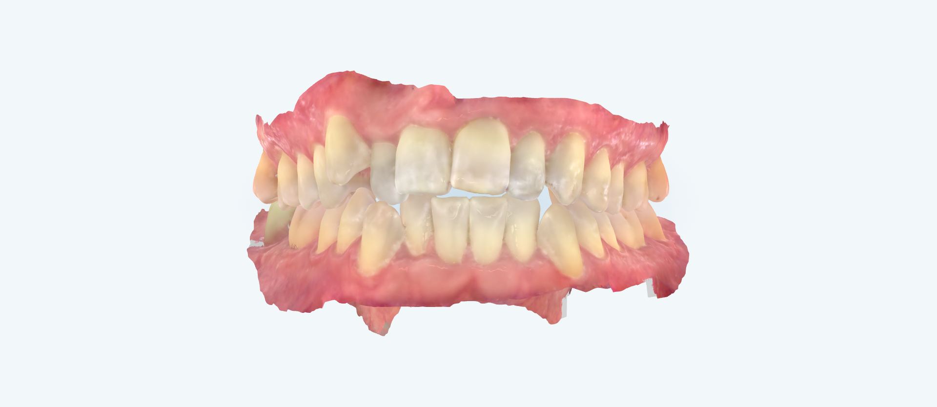 Crossbite treatment comparison case 3 before